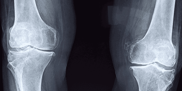 röntgenfoto knie